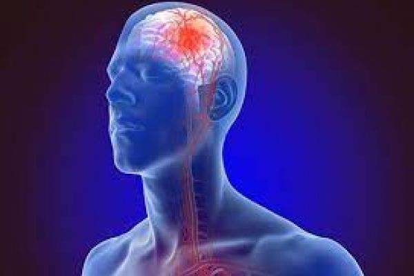 What Is An Ischemic Stroke Symptoms Causes Risk Factors Treatment