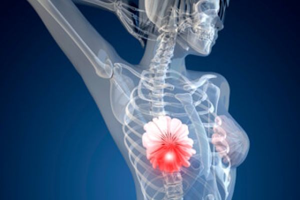 What is Breast Cancer? Causes, Symptoms & Prevention method