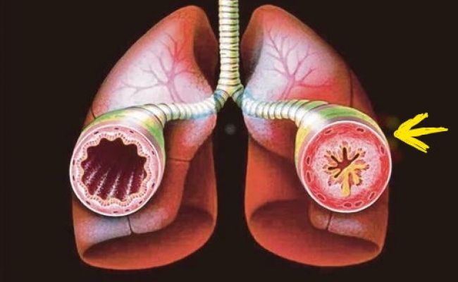 bronchial asthma essay symptoms