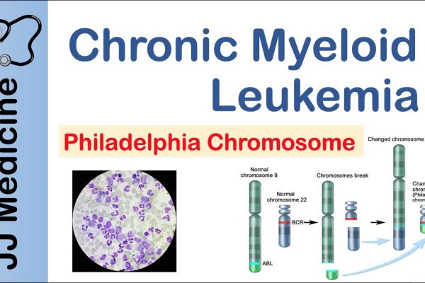 Leukemia Chronic Myelogenous Pictures