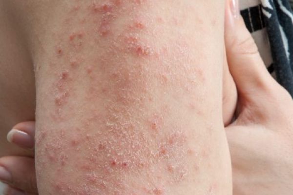 What Is Dermatitis Herpetiformis Symptoms Causes Diagnosis And