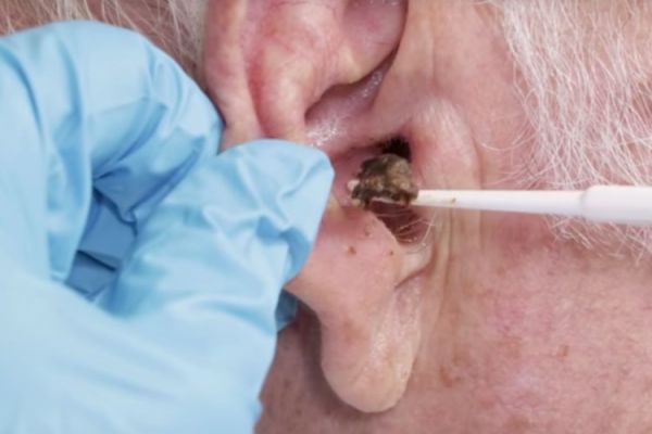 What Is Earwax Buildup? Symptoms, Causes, Treatment And Medical Help