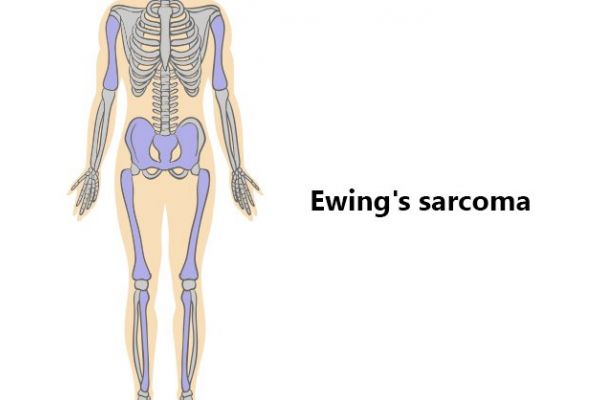 What Is Ewings Sarcoma Signs And Symptoms Causes Diagnosis 6887