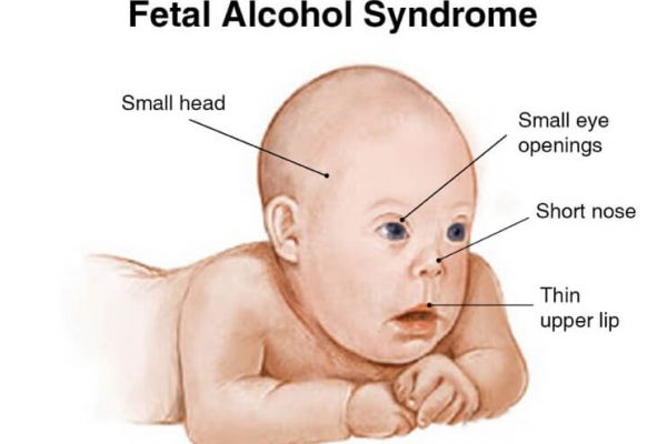 Symptoms of fetal alcohol syndrome