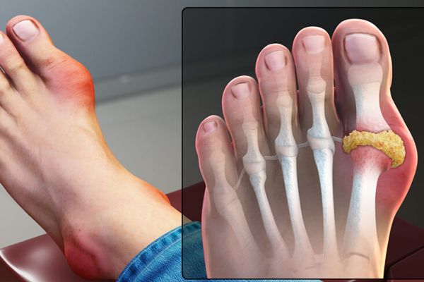 What is Gout? Types, Symptoms, Causes, Risk Factors, Treatment and ...