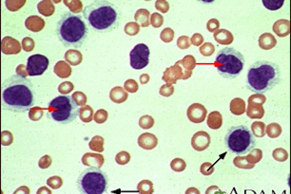 what-is-hairy-cell-leukemia-symptoms-causes-complications-diagnosis