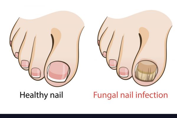 What is Nail Fungal Infection? Symptoms, Causes, Diagnosis, Treatment