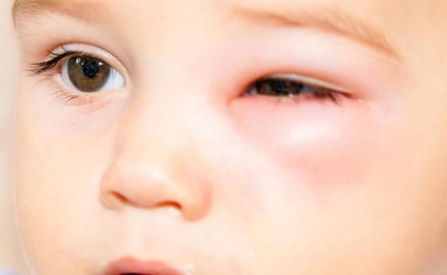 Periorbital Cellulitis Baby