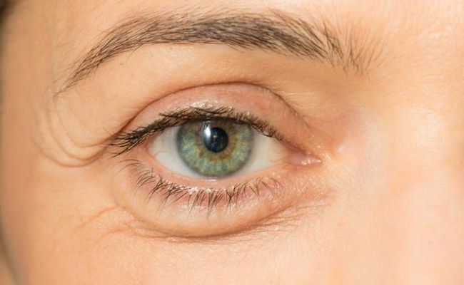 what-causes-puffy-eyes-what-are-the-symptoms-and-treatment