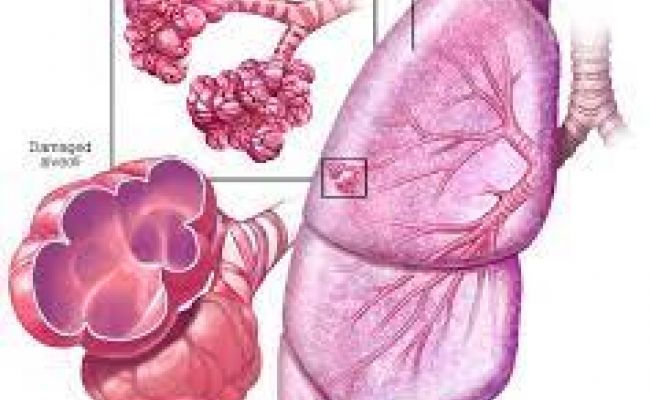 emphysema-causes-signs-symptoms-stages-expectancy-treatment